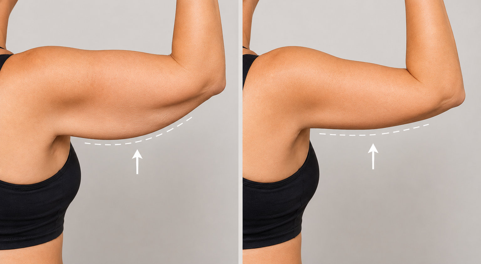 Woman showing her upper arm before brachioplasty treatment
